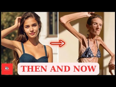 20 Celebrities You Won&#039;t Believe DlED OF ANOREXlA (Heartbreaking 2024 Update) | Then and now 2024